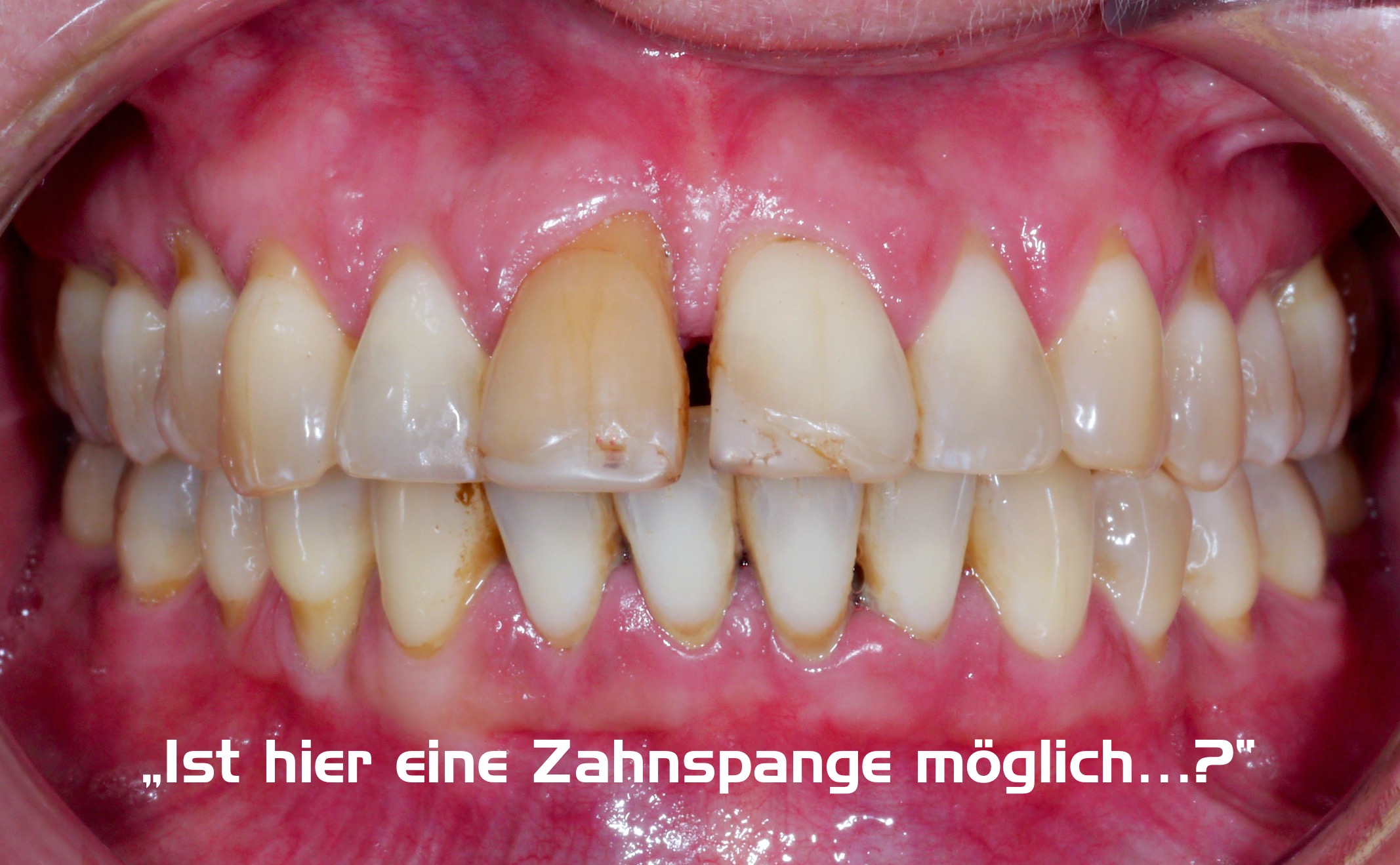 Orthodontic treatment of periodontitis patients – is such a thing possible...? Orthodontic treatment of periodontitis patients – is such a thing possible...?