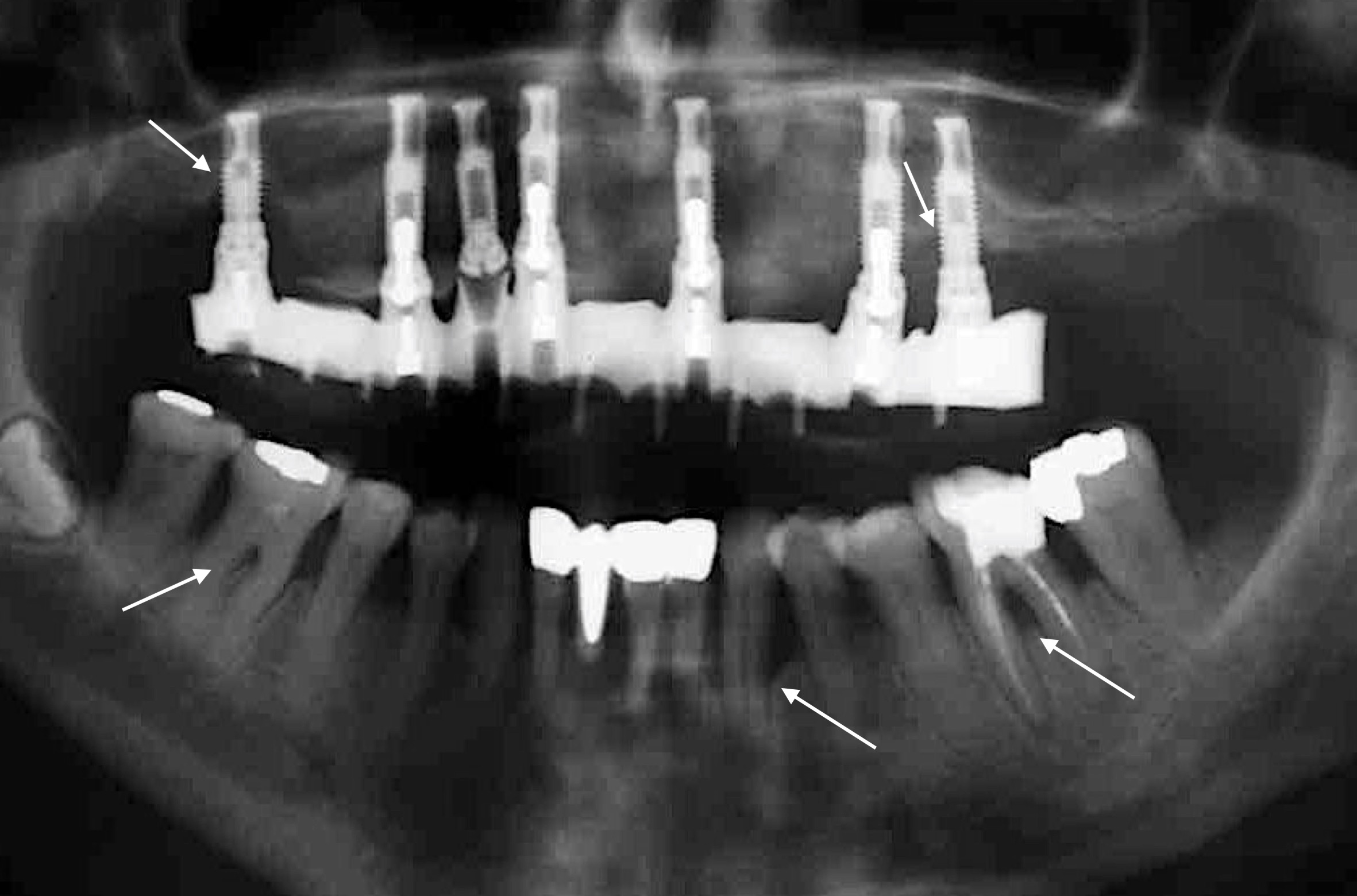 Periodontitis – is it a risk for peri-implantitis ...? (Shutterstock) Periodontitis – is it a risk for peri-implantitis ...? (Shutterstock)
