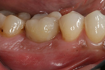 composite crown composite crown