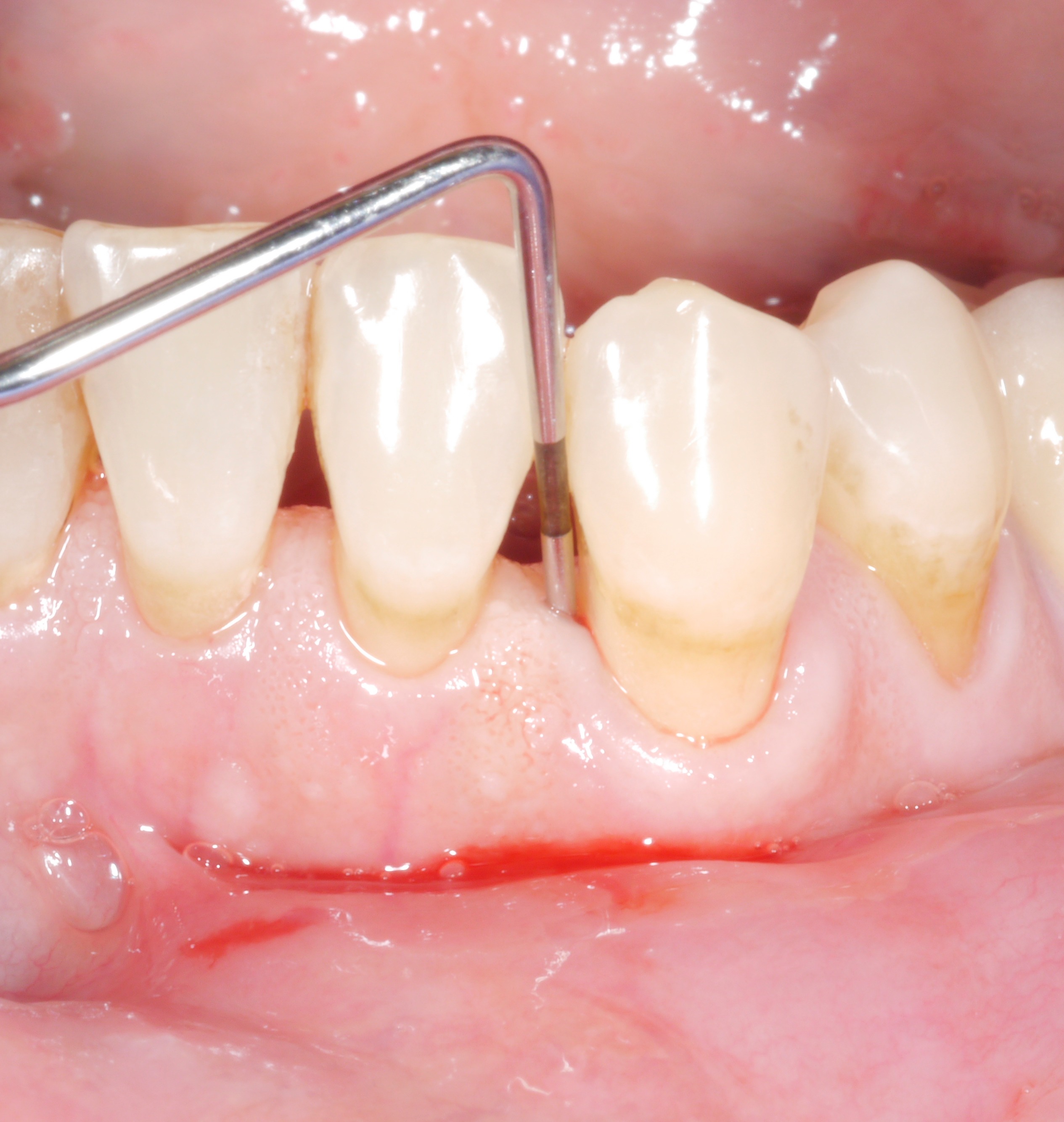 A residual pocket probing depth of 6 mm – is it a problem? A residual pocket probing depth of 6 mm – is it a problem?