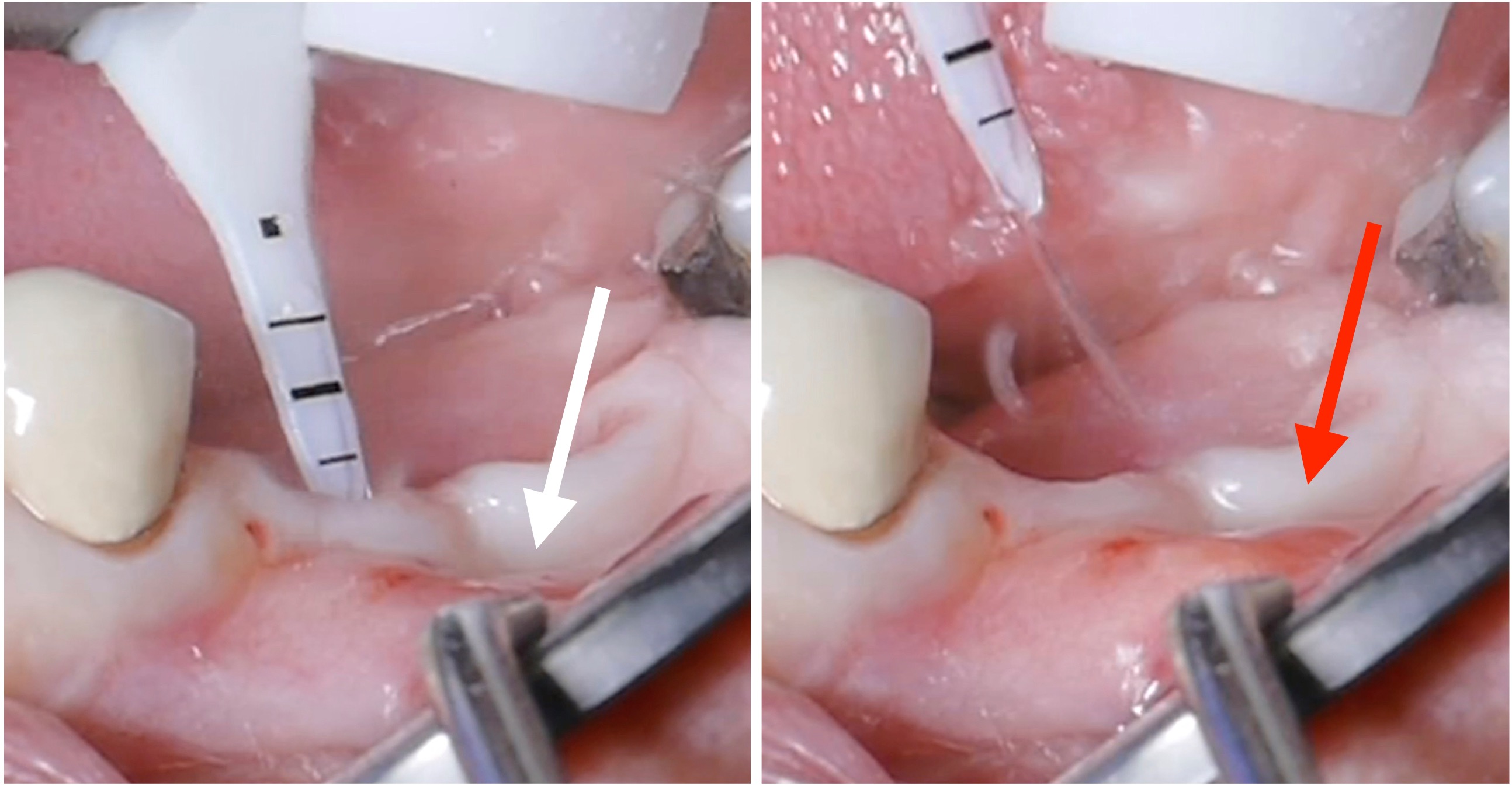 Air-polishing devices – are there any risks? Air-polishing devices – are there any risks?