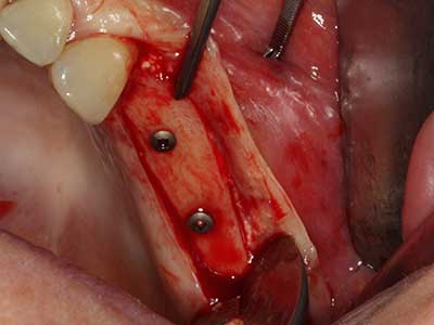 Piezo surgery Piezo surgery