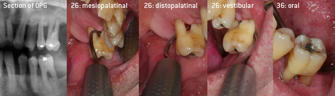 Closed debridement of the furcations on teeth 26 and 36 Closed debridement of the furcations on teeth 26 and 36