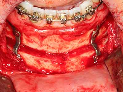 Piezo surgery Piezo surgery