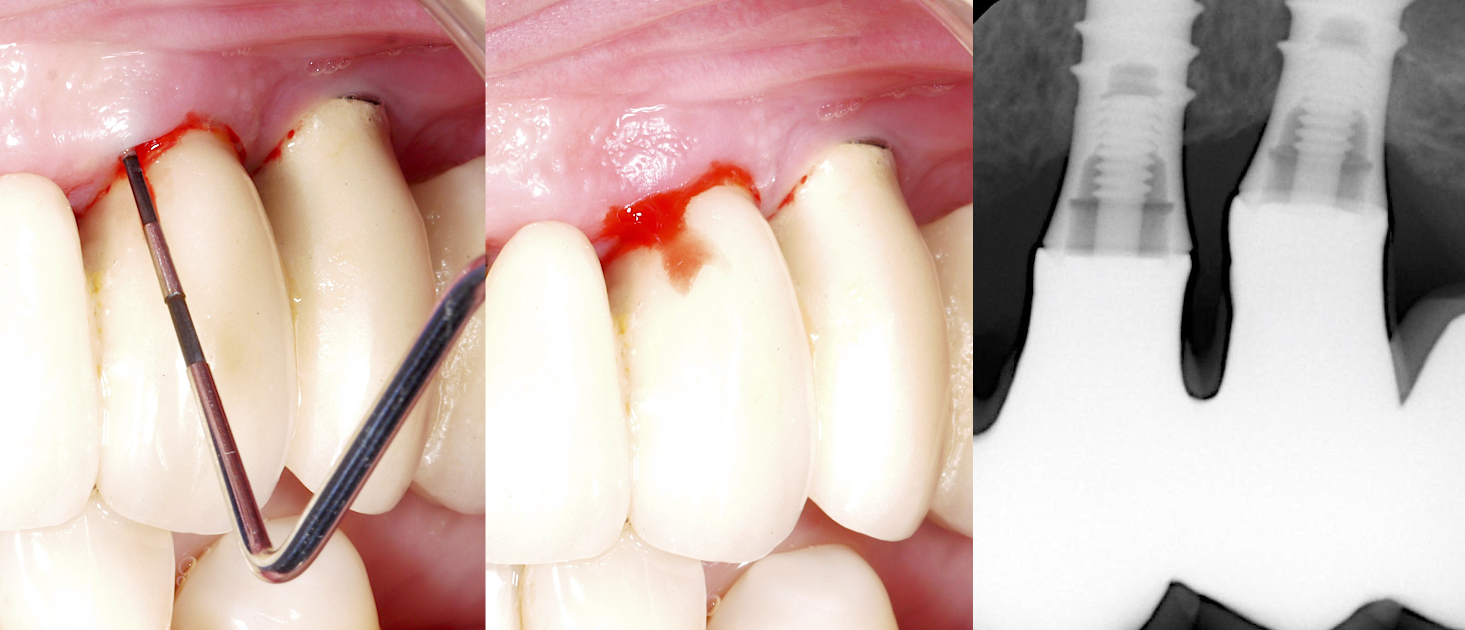 Peri-implantäre Mukositis richtig diagnostizieren! (Shutterstock) Peri-implantäre Mukositis richtig diagnostizieren! (Shutterstock)