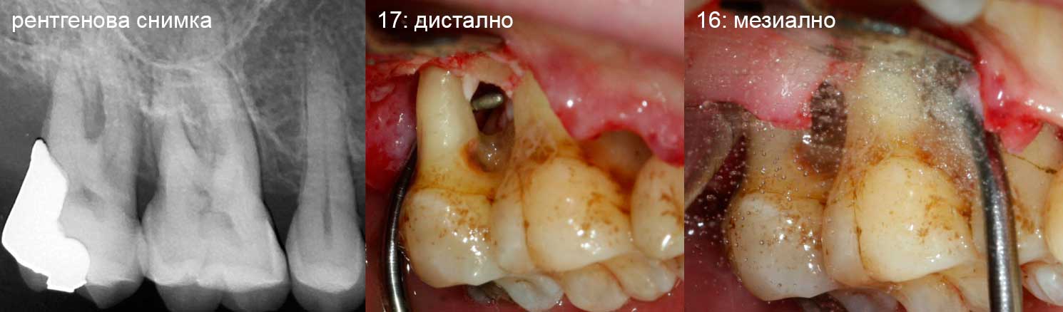 Отворено отстраняване на фуркации от зъби 16 и 17  Отворено отстраняване на фуркации от зъби 16 и 17