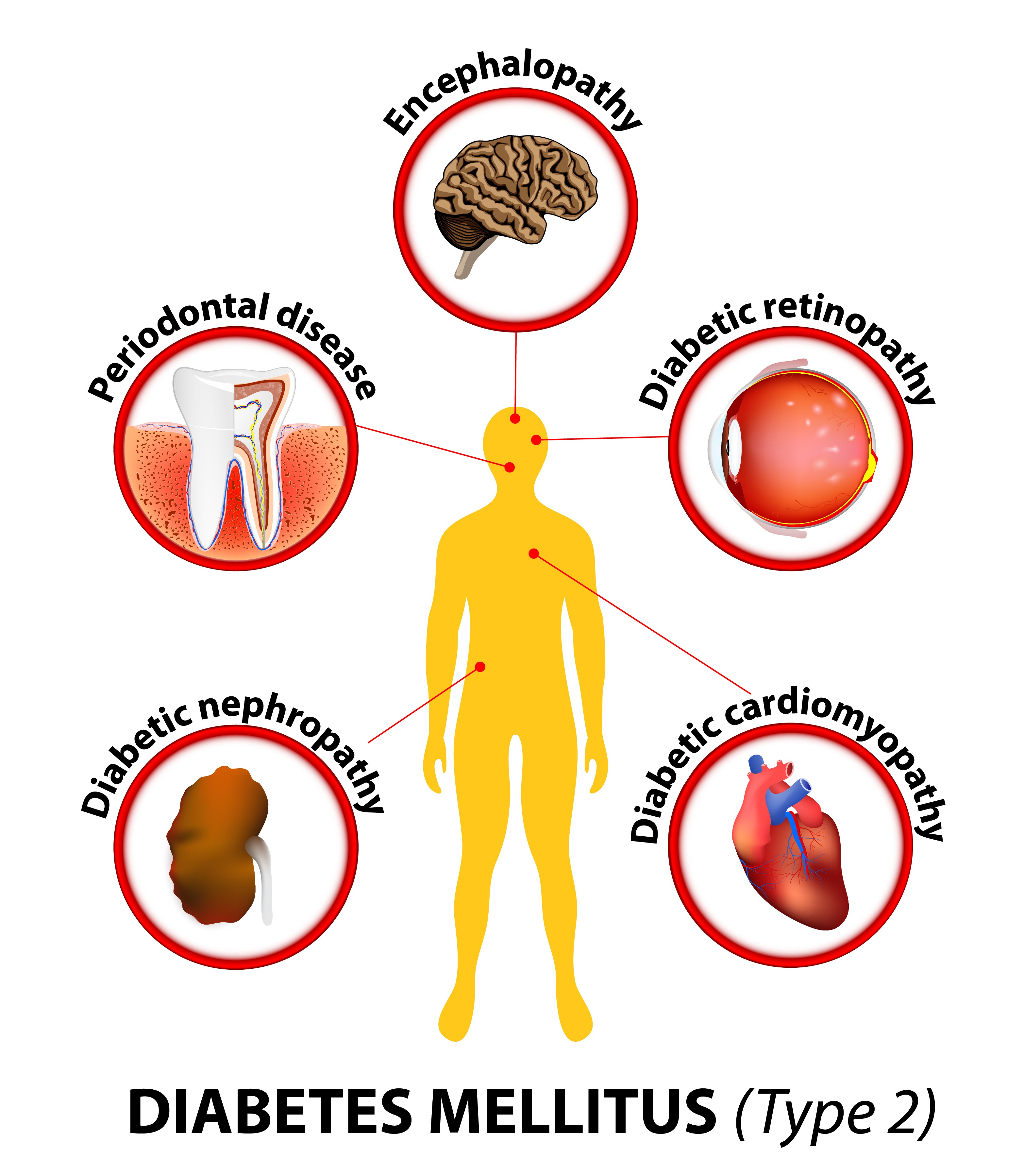 Parodontale Therapie bei DiabetespatientInnen – Was ist wichtig zu wissen? (Shutterstock) Parodontale Therapie bei DiabetespatientInnen – Was ist wichtig zu wissen? (Shutterstock)