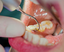 Piezo-Scaler Tigon+ Piezo-Scaler Tigon+