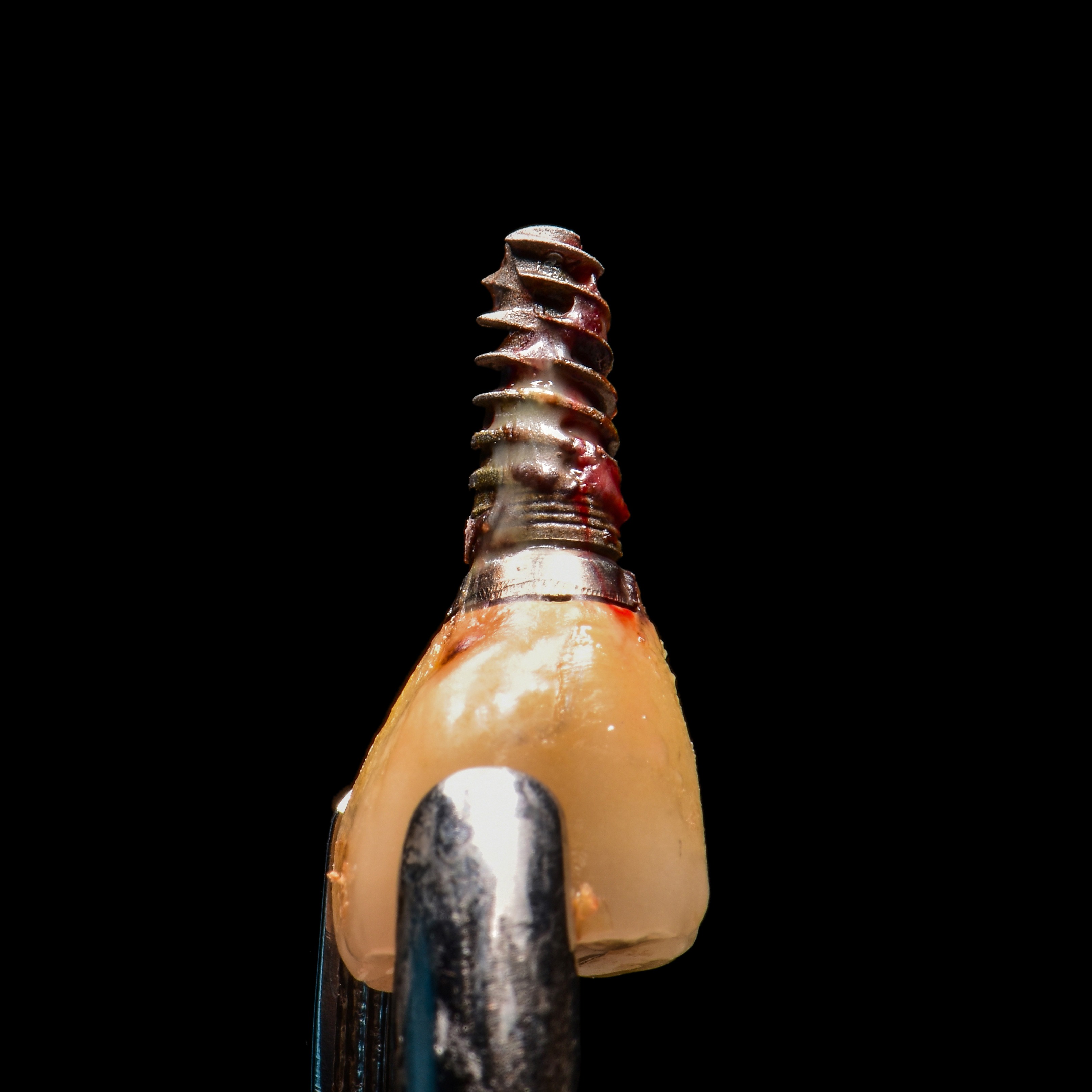 Peri-implantitis richtig diagnostizieren! (Shutterstock) Peri-implantitis richtig diagnostizieren! (Shutterstock)