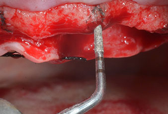 Markierung und Pilotaufbereitung mit dem Piezomed I1 Markierung und Pilotaufbereitung mit dem Piezomed I1