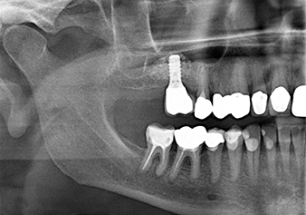 The x-ray check shows a largely homogeneous peri-implant hard tissue structure The x-ray check shows a largely homogeneous peri-implant hard tissue structure