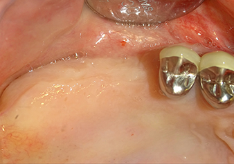 Preoperative findings: The alveolar ridge has healed well, including sufficiently broad, keratinised gingiva Preoperative findings: The alveolar ridge has healed well, including sufficiently broad, keratinised gingiva