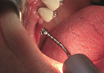 Implantatbettaufbereitung mit Instrument I4P Implantatbettaufbereitung mit Instrument I4P