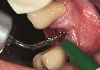 Périotome à denture fine (insert EX1) Périotome à denture fine (insert EX1)