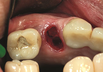 Situation post-extraction piézochirurgicale Situation post-extraction piézochirurgicale