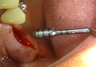 The fibrous membrane is raised into its final position The fibrous membrane is raised into its final position