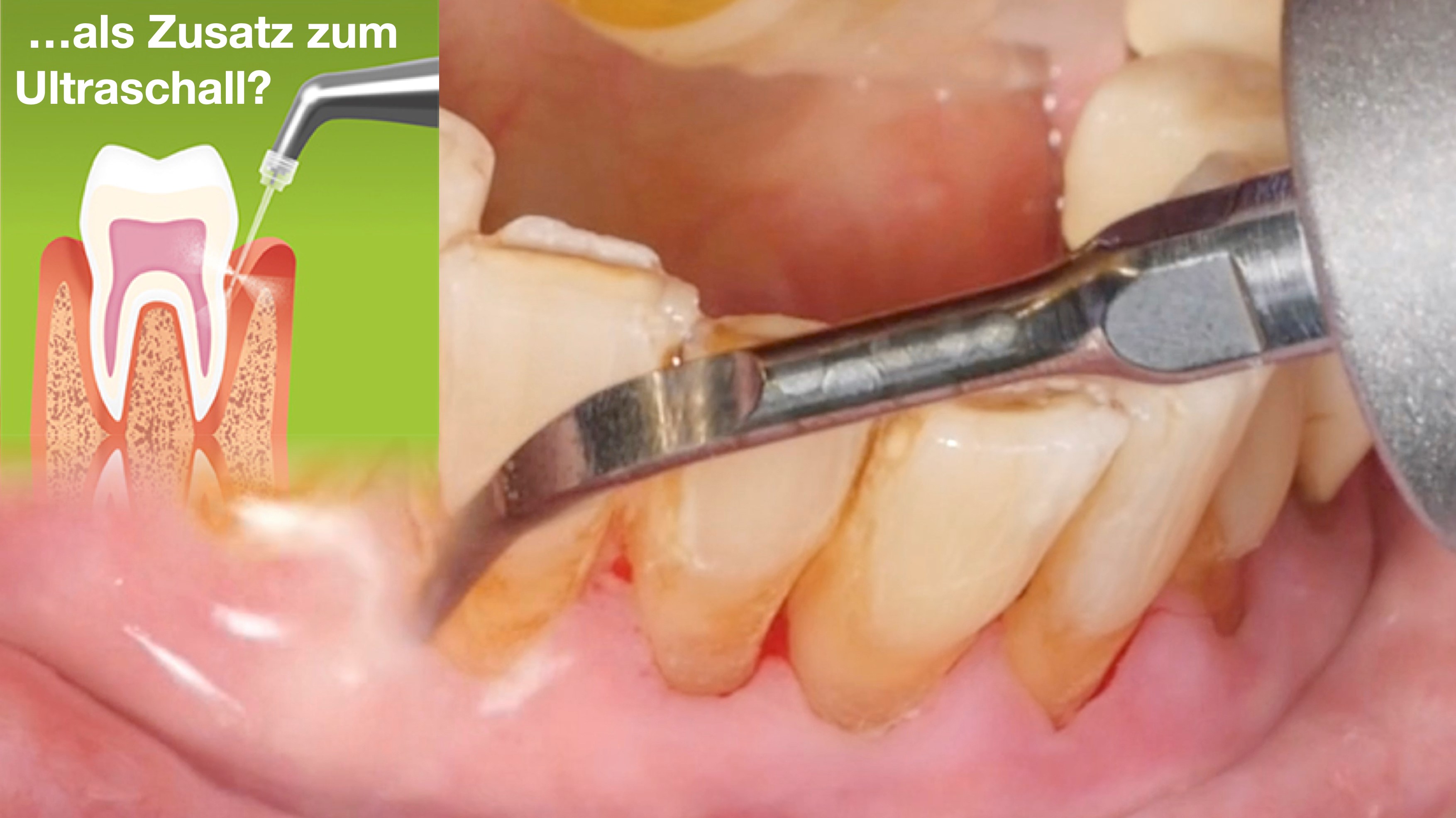 Pulverstrahl als Zusatz zum Ultraschall? (Shutterstock) Pulverstrahl als Zusatz zum Ultraschall? (Shutterstock)