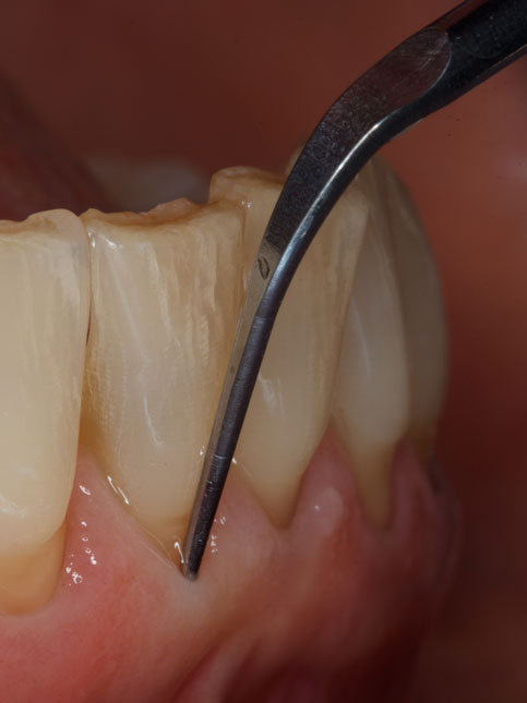 Ultrasound devices make hard plaque removal work more efficient. The proven compatibility of a cardiac pacemaker is important to patient safety in this segment. Ultrasound devices make hard plaque removal work more efficient. The proven compatibility of a cardiac pacemaker is important to patient safety in this segment.