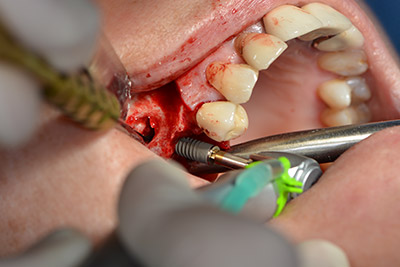 Augmentation with autologous bone Augmentation with autologous bone