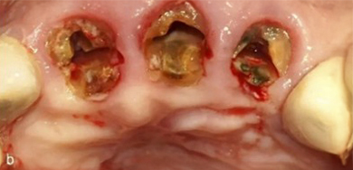 Figura b: Posicionándolo en el espacio del ligamento periodontal a nivel de los fragmentos palatinos. Figura b: Posicionándolo en el espacio del ligamento periodontal a nivel de los fragmentos palatinos.