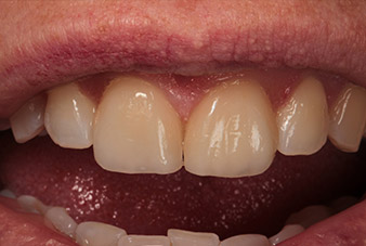 Unmittelbare postoperative Ansicht Unmittelbare postoperative Ansicht