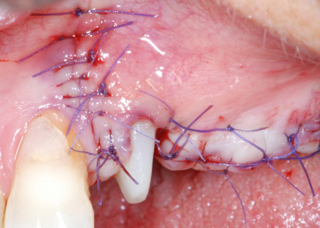 Surgical site after tension-free suturing Surgical site after tension-free suturing