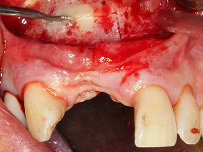 Piezosurgery Piezosurgery