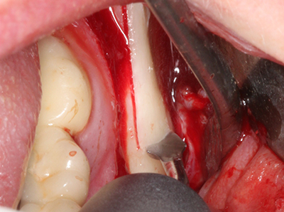 Piezosurgery Piezosurgery