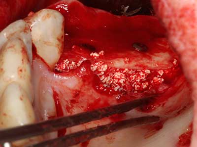 Piezosurgery Piezosurgery