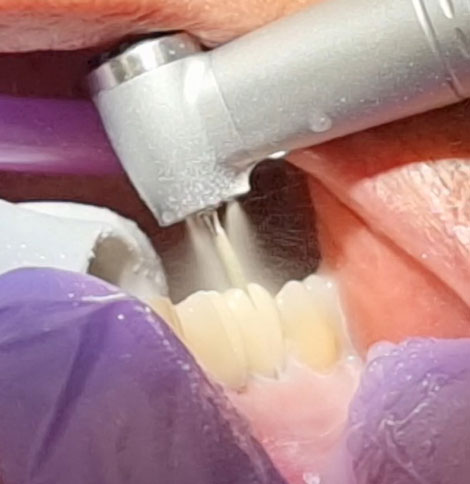 The W&H Synea Power Edition has been specially developed for processing zirconia. The W&H Synea Power Edition has been specially developed for processing zirconia.