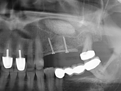 Piezosurgery Piezosurgery