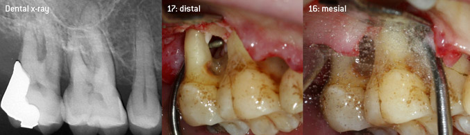 Open debridement of the furcations on teeth 16 and 17 Open debridement of the furcations on teeth 16 and 17