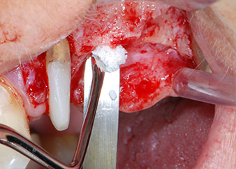 Sonda CPITN Sonda CPITN