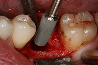 Implantat Implantat