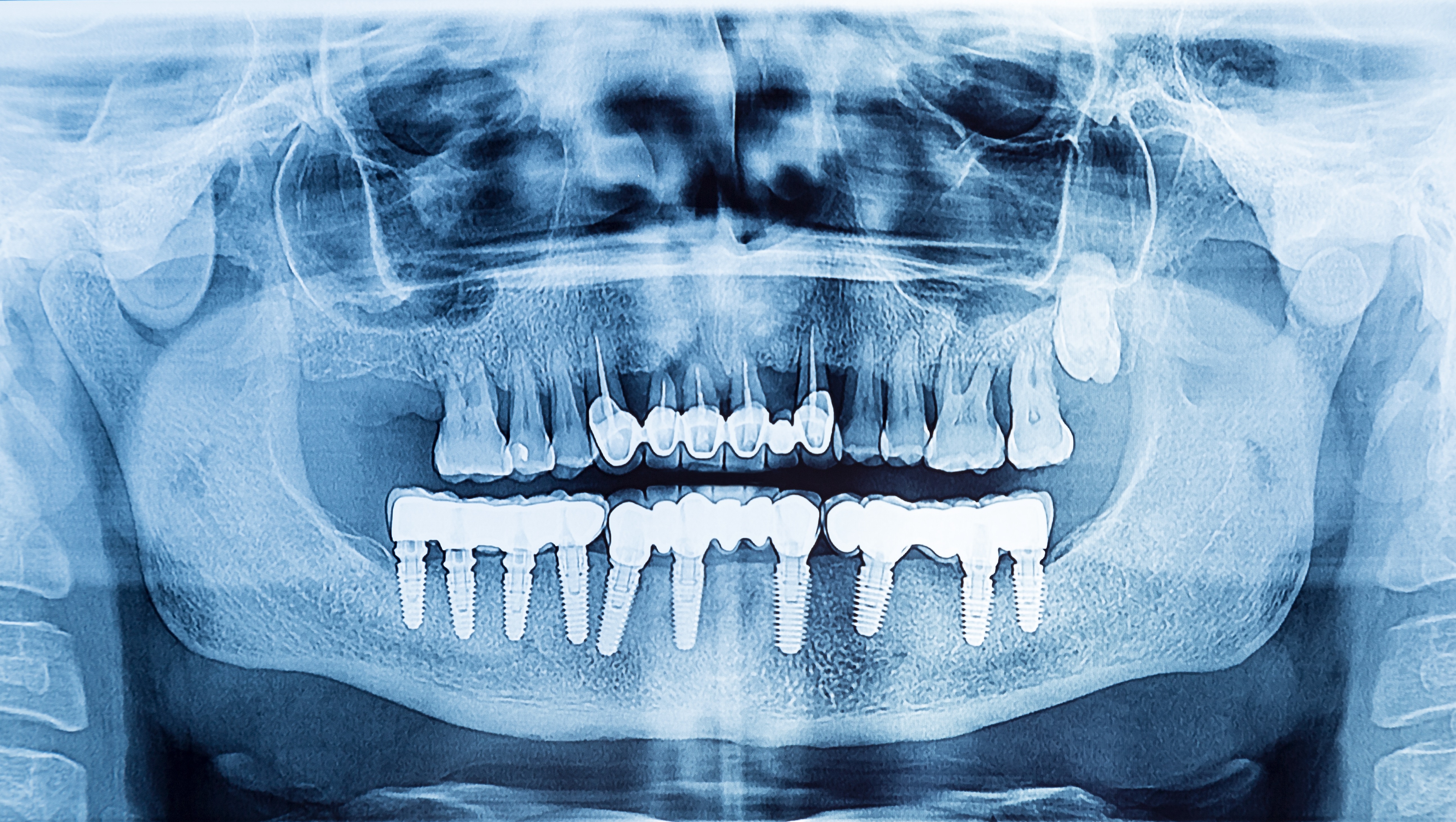 Taking good implant X-rays made easy! (Shutterstock) Taking good implant X-rays made easy! (Shutterstock)