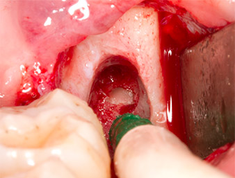 resto radicular 38  resto radicular 38