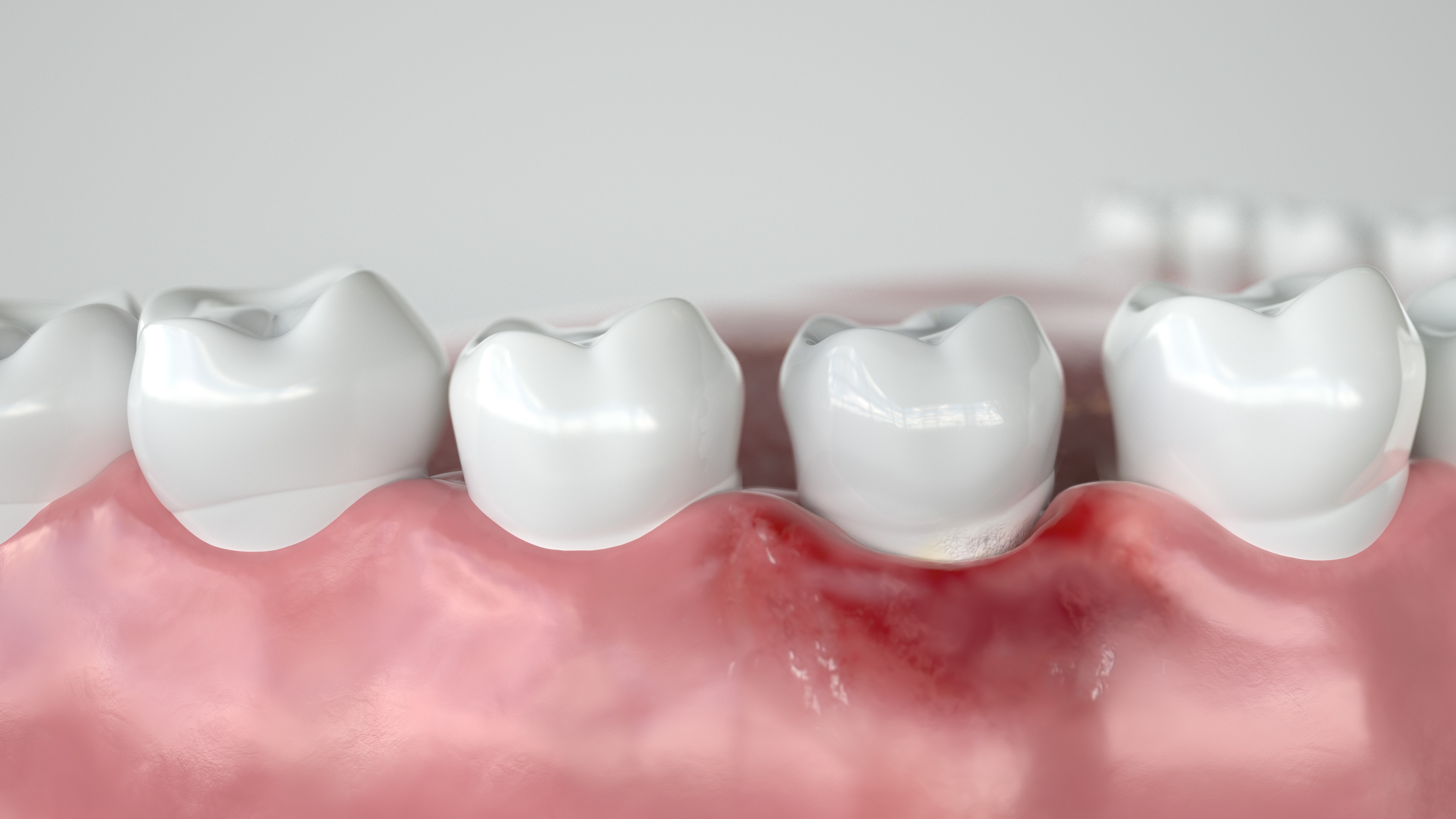 How to correctly diagnose peri-implant mucositis How to correctly diagnose peri-implant mucositis