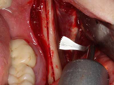 Piezo surgery Piezo surgery