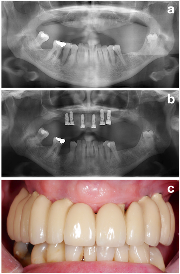 Figure 2. A stable periodontal situation should be established prior to implant installation. Patient prior to periodontal treatment (a), after periodontal treatment and implant installation (b), and after prosthetic restoration (c). © Dr. K. Bertl Figure 2. A stable periodontal situation should be established prior to implant installation. Patient prior to periodontal treatment (a), after periodontal treatment and implant installation (b), and after prosthetic restoration (c). © Dr. K. Bertl