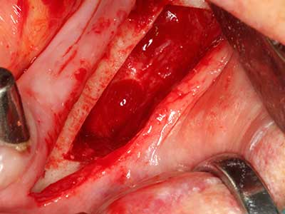 Piezosurgery Piezosurgery