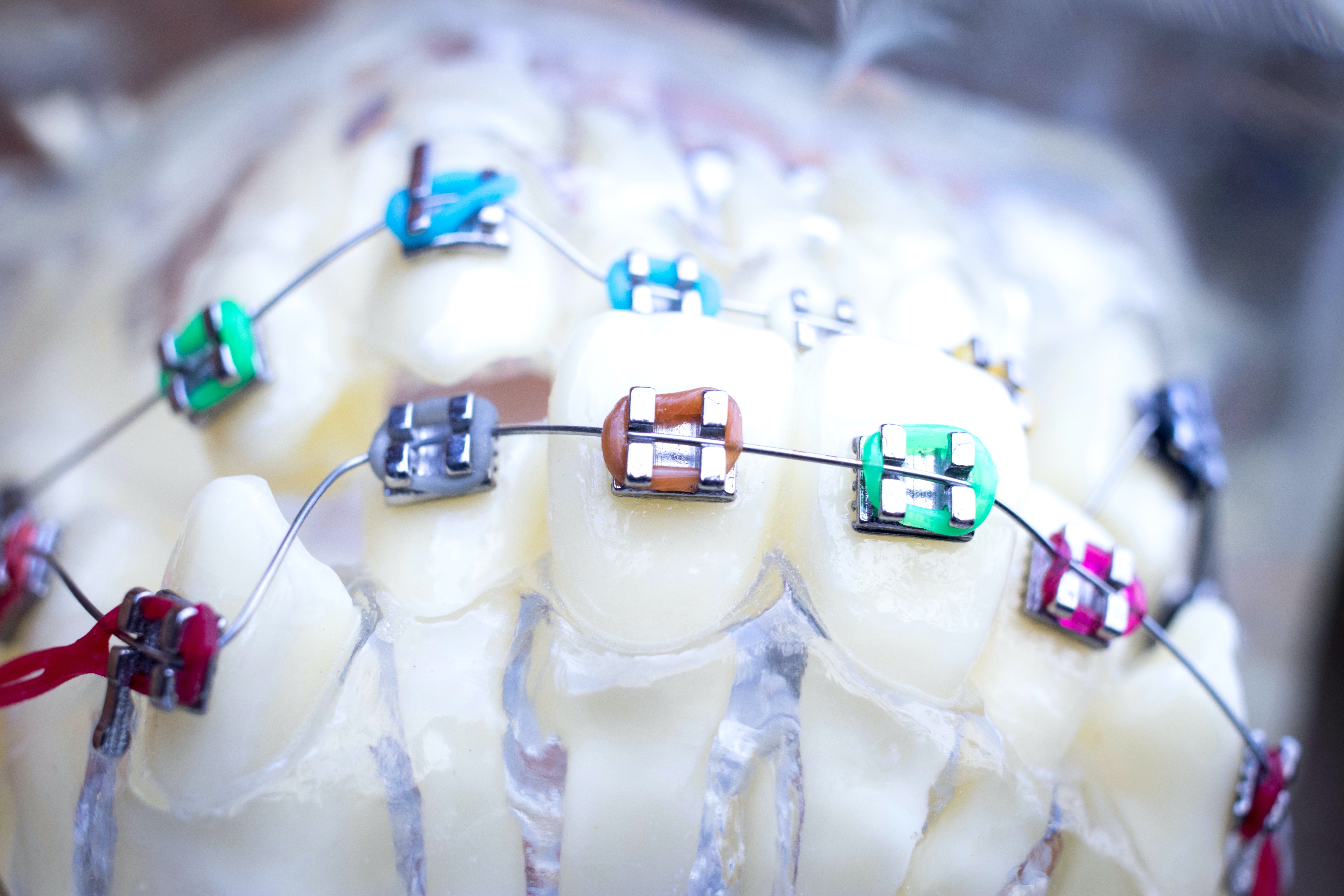 Is a manual or an electric toothbrush better during orthodontic treatment? Is a manual or an electric toothbrush better during orthodontic treatment?