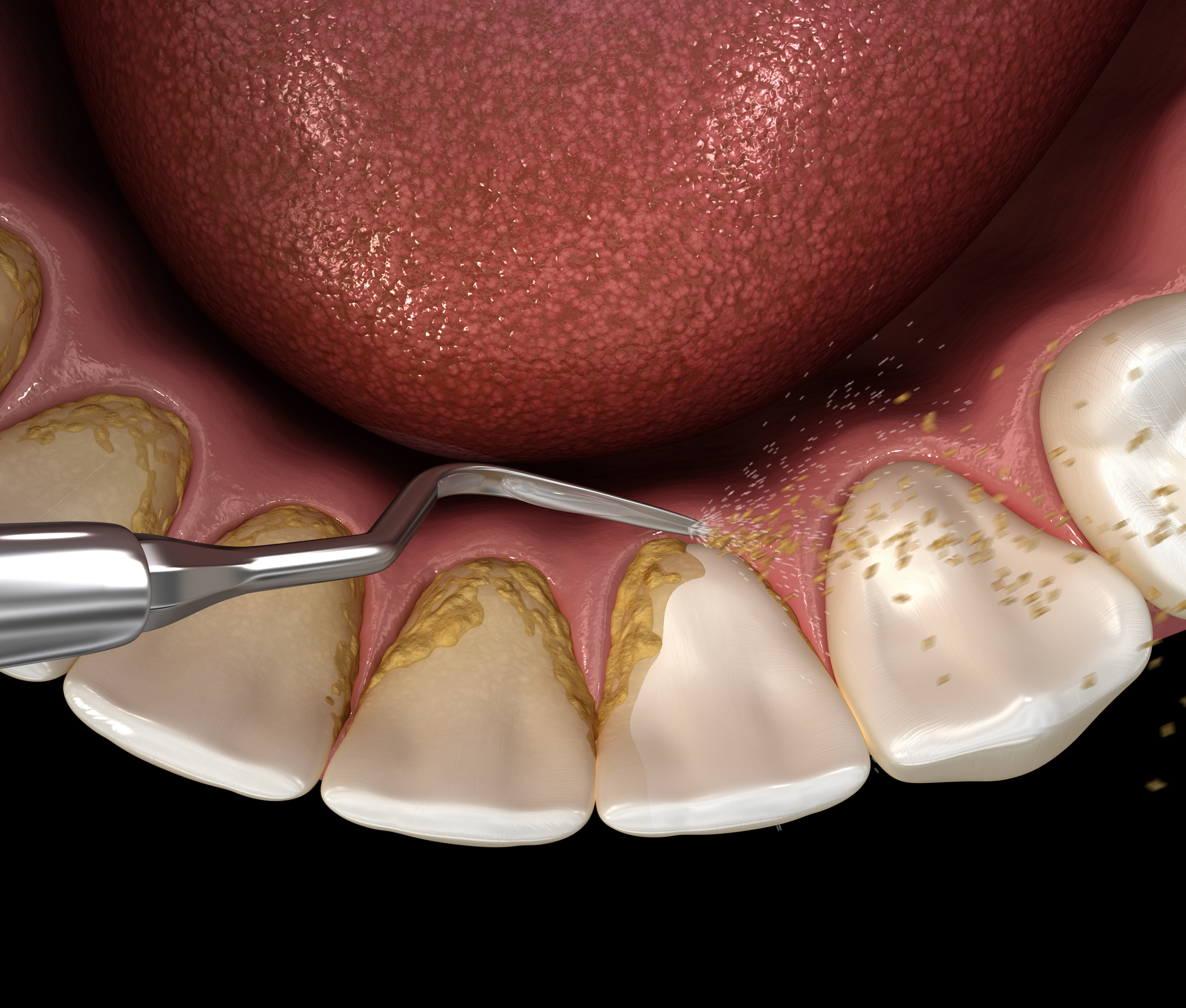 S3 Leitlinie – Subgingivale Instrumentierung! (Shutterstock) S3 Leitlinie – Subgingivale Instrumentierung! (Shutterstock)