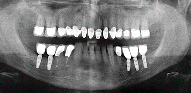 Abb. 3: Panoramaschichtaufnahme nach einer prothetischen Funktionsperiode von zehn Jahren. Abb. 3: Panoramaschichtaufnahme nach einer prothetischen Funktionsperiode von zehn Jahren.