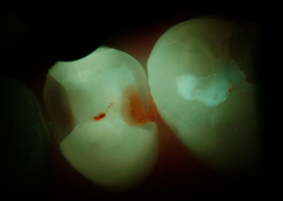 Whereas healthy tooth substance is distinguished by a characteristic green fluorescence under the light probe, bacterially infected areas are clearly identifiable by their red fluorescence. Whereas healthy tooth substance is distinguished by a characteristic green fluorescence under the light probe, bacterially infected areas are clearly identifiable by their red fluorescence.