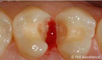 Fig. 7: Caries has been completely removed, uncertainties approximal. Fig. 7: Caries has been completely removed, uncertainties approximal.