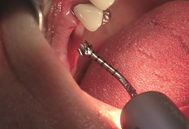 Piezochirurgie – ein breites Anwendungsspektrum in der oralen Chirurgie