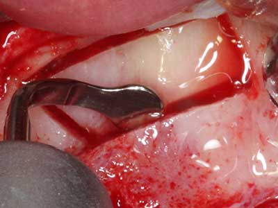 Piezosurgery Piezosurgery