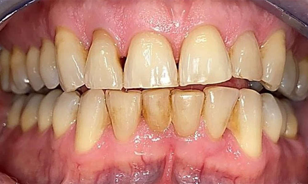 Frontal view with loss of the interdental papillae between 12 and 11. Frontal view with loss of the interdental papillae between 12 and 11.