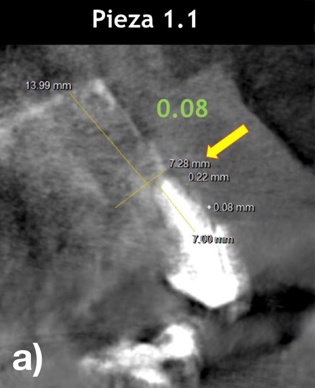 Figura: La radiografía revela cortes tomográficos sagitales de las piezas 1.1, 2.1, 2.2. con tablas óseas vestibulares bastante finas menores a 0.2 mm de espesor (a, c). Figura: La radiografía revela cortes tomográficos sagitales de las piezas 1.1, 2.1, 2.2. con tablas óseas vestibulares bastante finas menores a 0.2 mm de espesor (a, c).