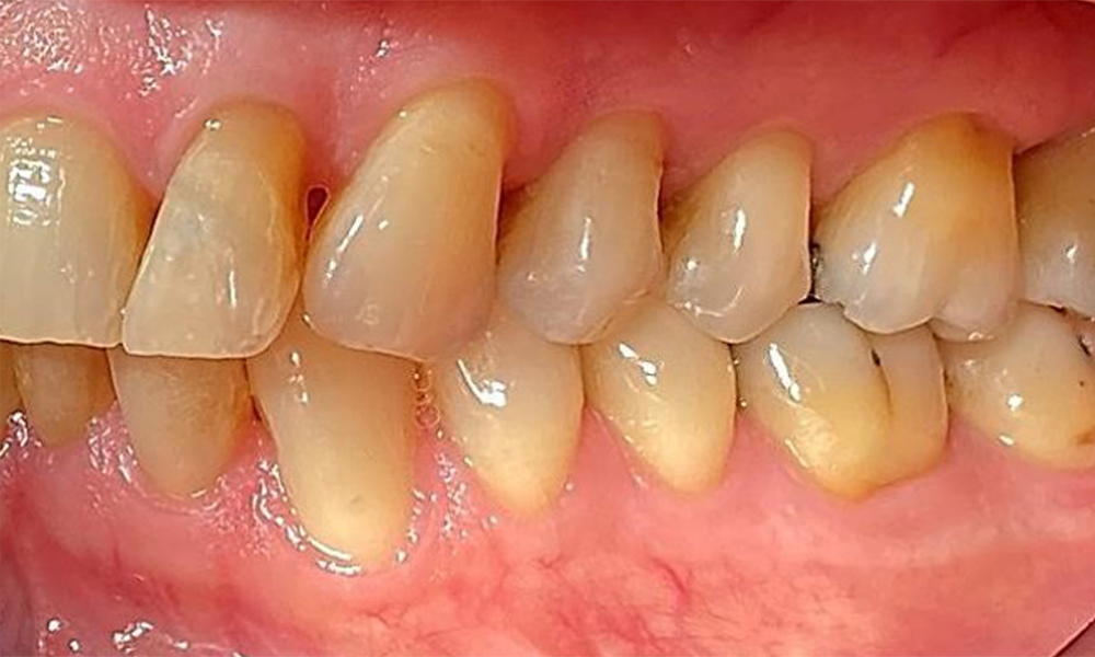 Изглед от лявата страна, включващ рецесиите. Изглед от лявата страна, включващ рецесиите.